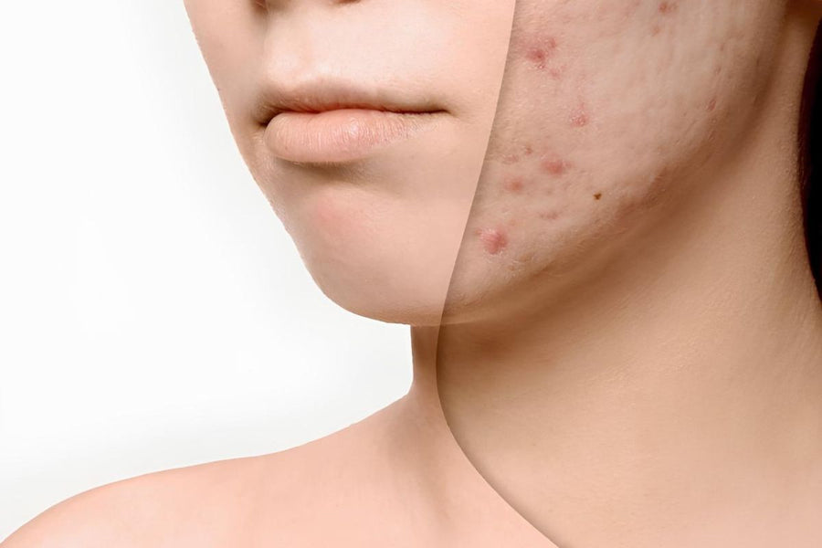 Kosmetyki na blizny potrądzikowe - jakie kwasy będą najbardziej skuteczne?