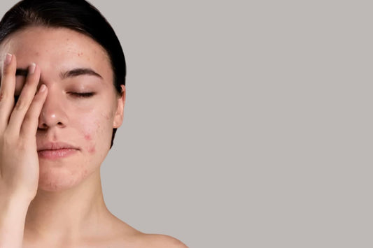 Cera trądzikowa - codzienna pielęgnacja krok po kroku