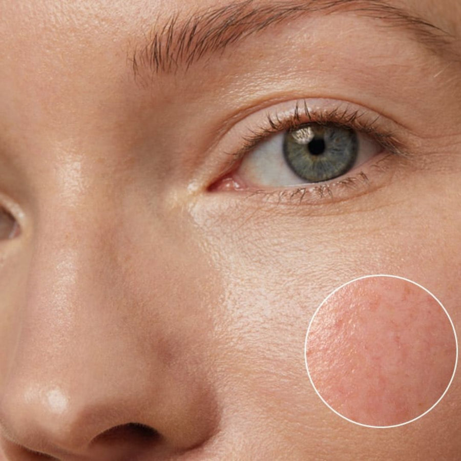 Zaczerwienienie skóry - przyczyny, objawy i skuteczna pielęgnacja domowa