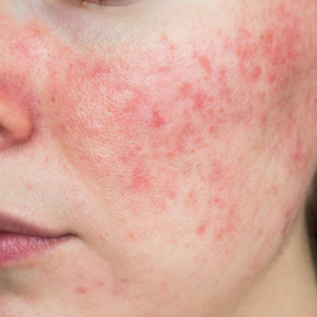 Jak Skutecznie Zadbać o Skórę z Trądzikiem Różowatym? Praktyczny Poradnik LuxDermaStore